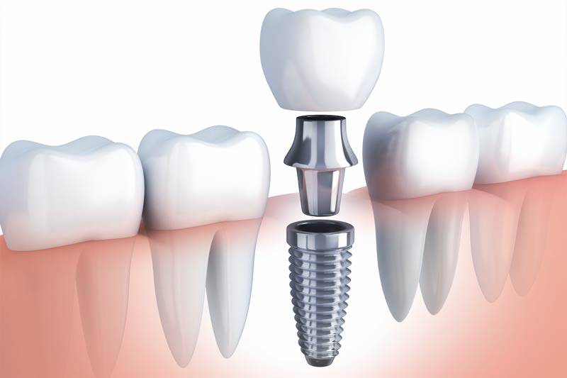 Implants Dentist in Flint