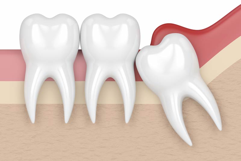 Wisdom Tooth Removal in Flint